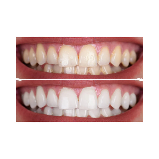Por que os dentes ficam manchados? – Causas e Prevenção