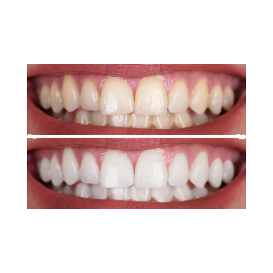 Por que os dentes ficam manchados? – Causas e Prevenção